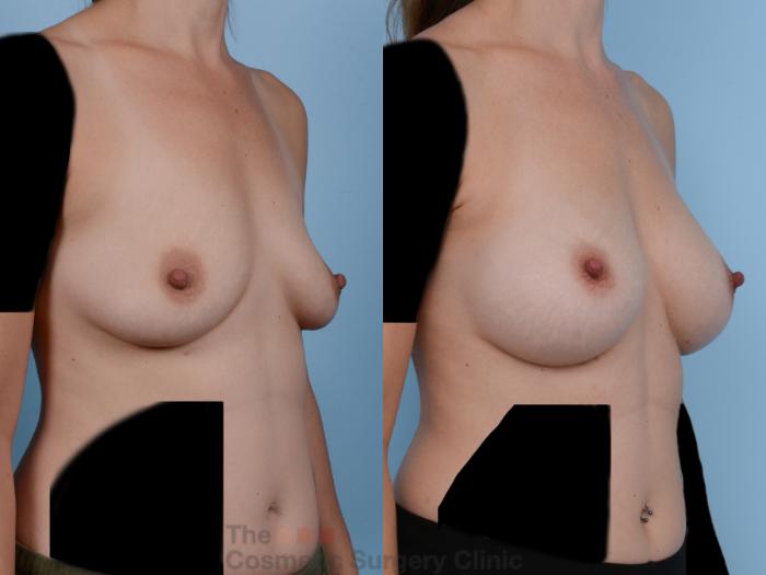 Before & After Breast Augmentation Case 244 View #4 View in Waterloo, Ontario
