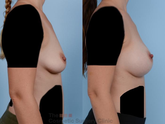 Before & After Breast Augmentation Case 244 View #5 View in Waterloo, Ontario