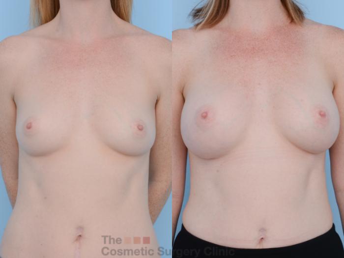Before & After Breast Augmentation Case 319 View #1 View in Waterloo, Ontario