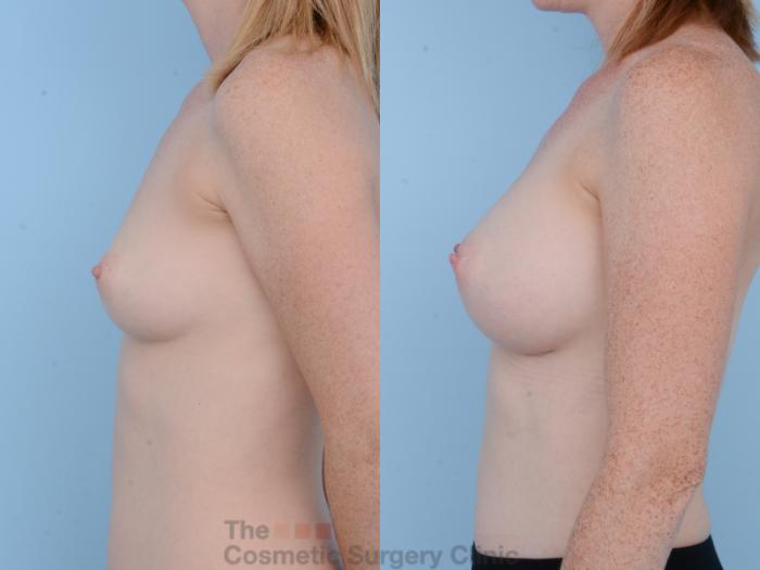Before & After Breast Augmentation Case 319 View #2 View in Waterloo, Ontario