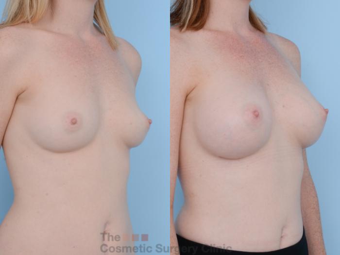 Before & After Breast Augmentation Case 319 View #4 View in Waterloo, Ontario
