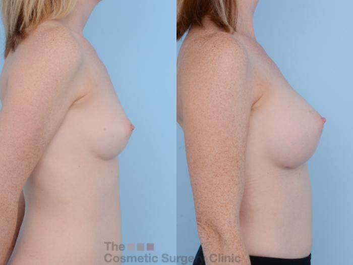 Before & After Breast Augmentation Case 319 View #5 View in Waterloo, Ontario