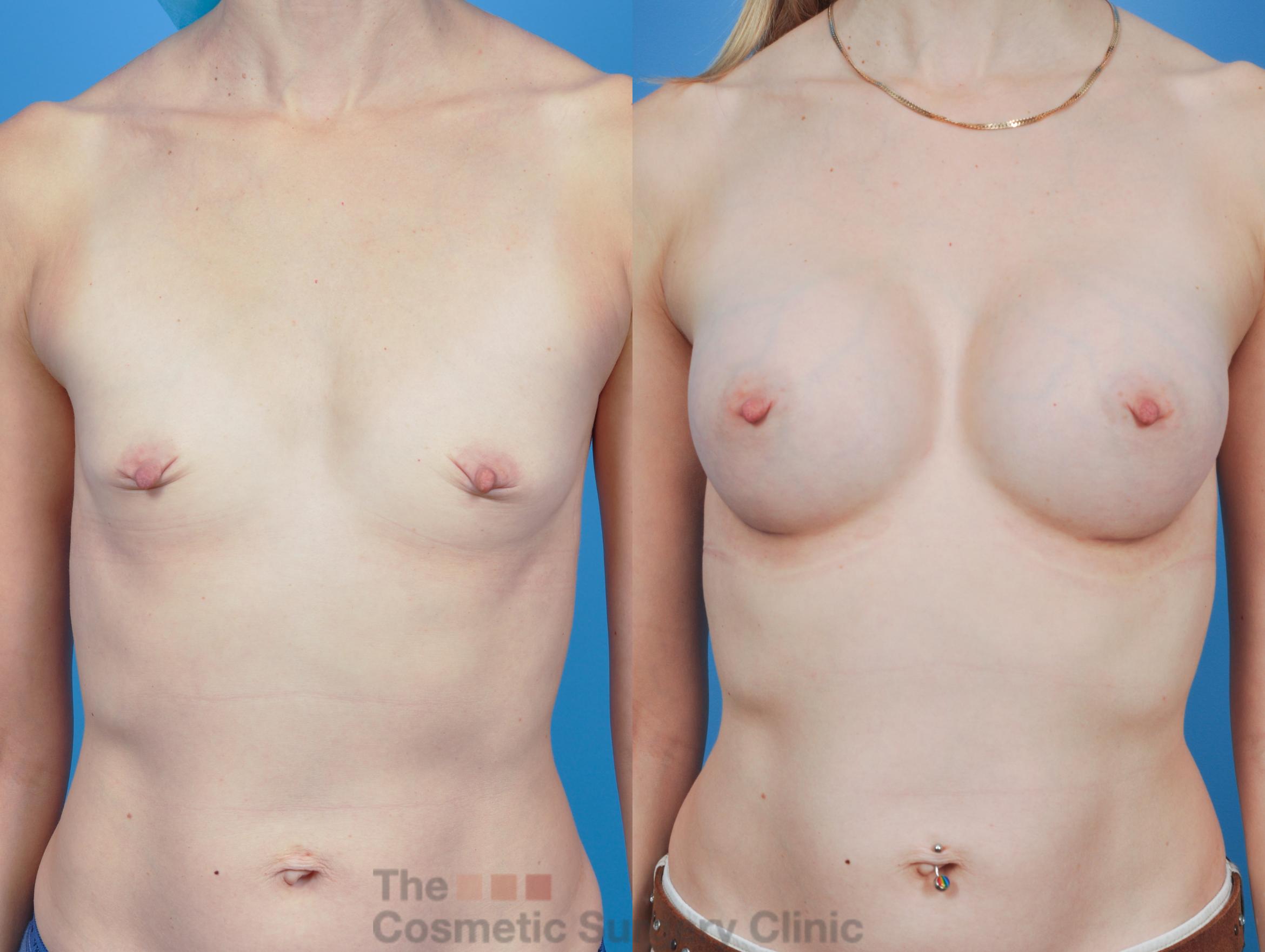 Before & After Breast Augmentation Case 343 View #1 View in Waterloo, Ontario