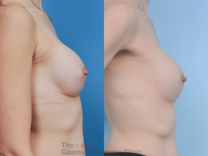 Before & After Breast Augmentation Case 343 View #10 View in Waterloo, Ontario