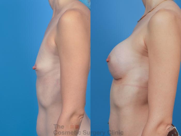 Before & After Breast Augmentation Case 343 View #2 View in Waterloo, Ontario