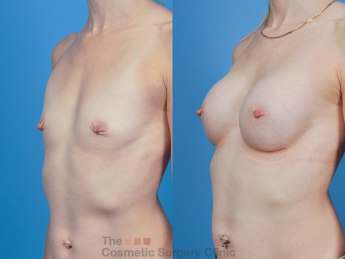 Before & After Breast Augmentation Case 343 View #3 View in Waterloo, Ontario