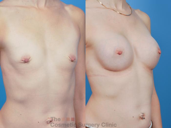 Before & After Breast Augmentation Case 343 View #4 View in Waterloo, Ontario