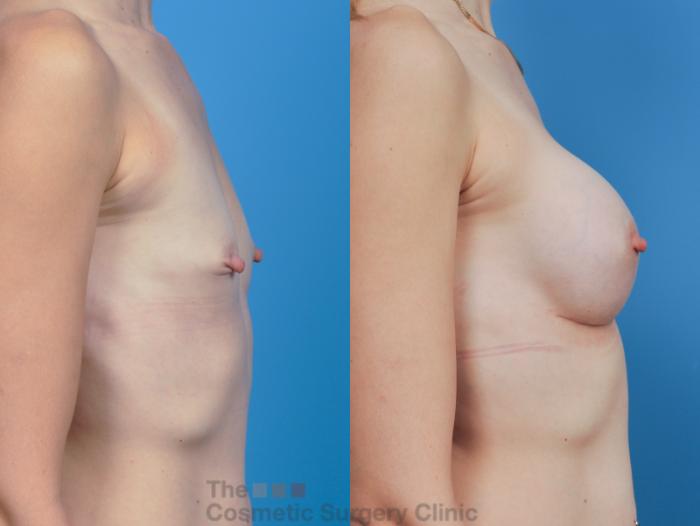 Before & After Breast Augmentation Case 343 View #5 View in Waterloo, Ontario