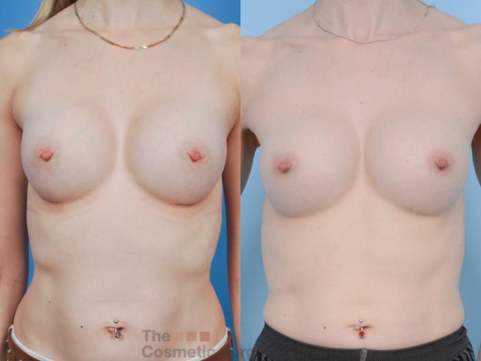 Before & After Breast Augmentation Case 343 View #6 View in Waterloo, Ontario