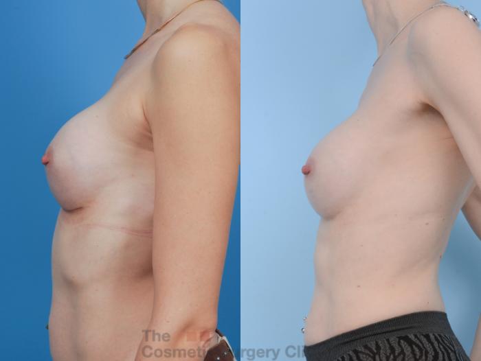 Before & After Breast Augmentation Case 343 View #7 View in Waterloo, Ontario
