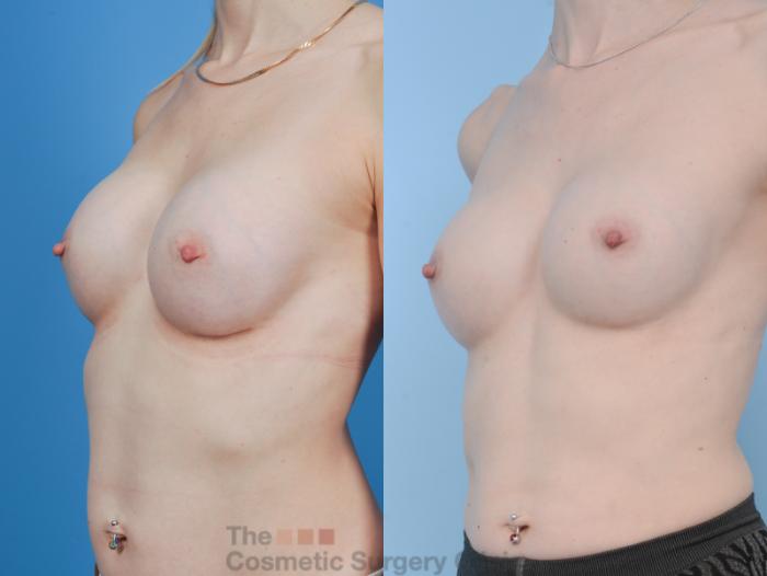 Before & After Breast Augmentation Case 343 View #8 View in Waterloo, Ontario