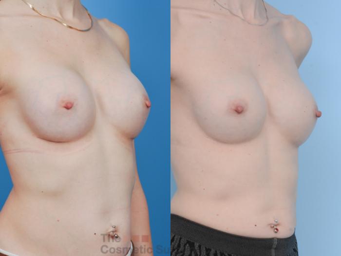 Before & After Breast Augmentation Case 343 View #9 View in Waterloo, Ontario