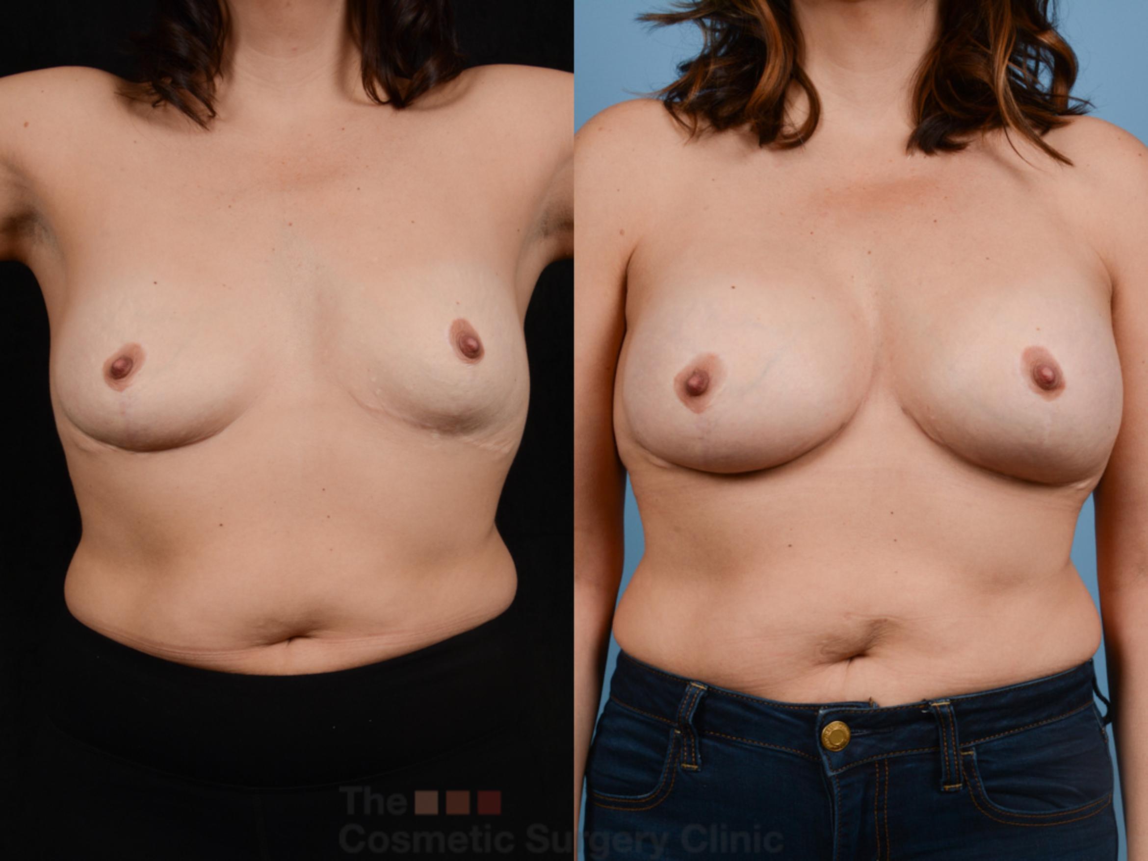 Before & After Breast Augmentation Case 358 View #1 View in Waterloo, Ontario