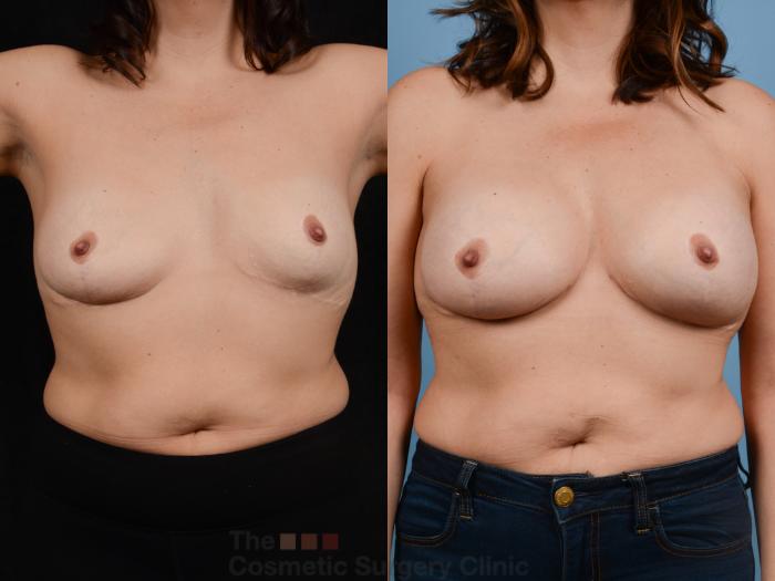 Before & After Breast Augmentation Case 358 View #1 View in Waterloo, Ontario
