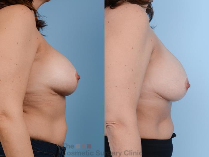 Before & After Breast Augmentation Case 358 View #10 View in Waterloo, Ontario