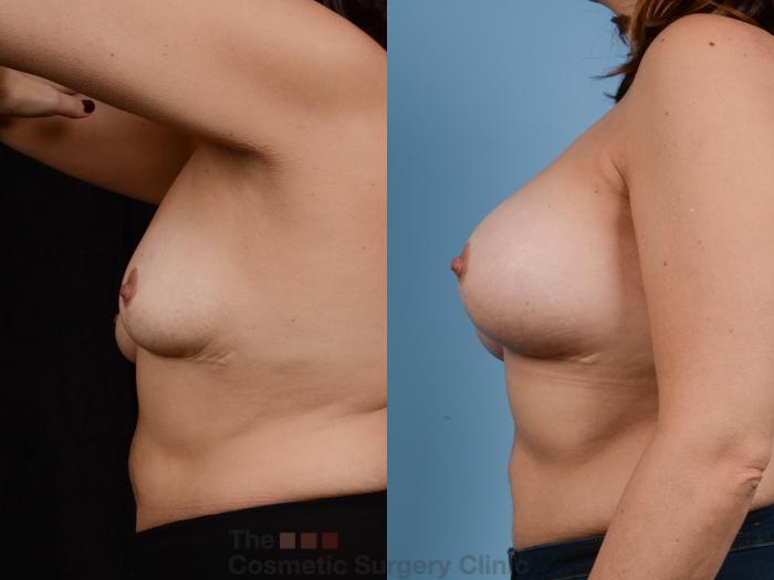 Before & After Breast Augmentation Case 358 View #2 View in Waterloo, Ontario