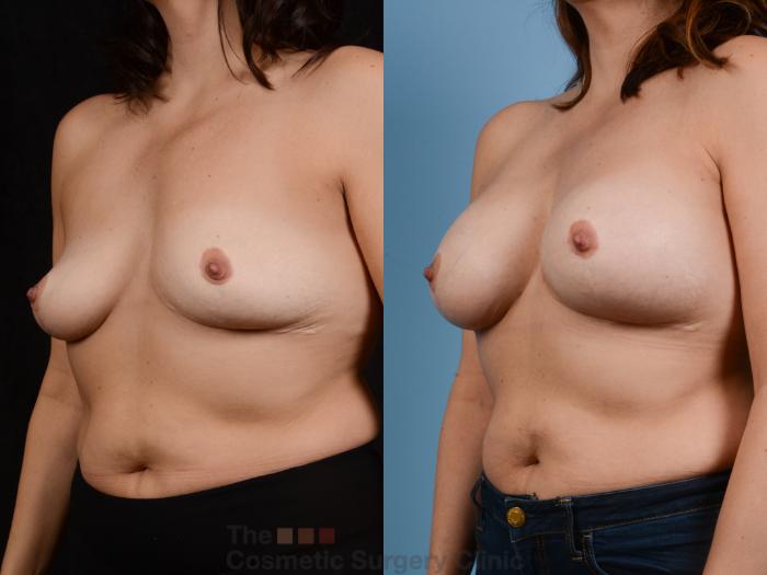 Before & After Breast Augmentation Case 358 View #3 View in Waterloo, Ontario