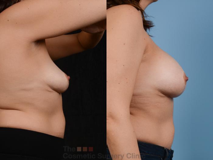 Before & After Breast Augmentation Case 358 View #5 View in Waterloo, Ontario