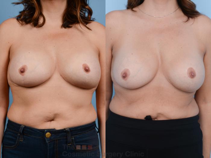 Before & After Breast Augmentation Case 358 View #6 View in Waterloo, Ontario