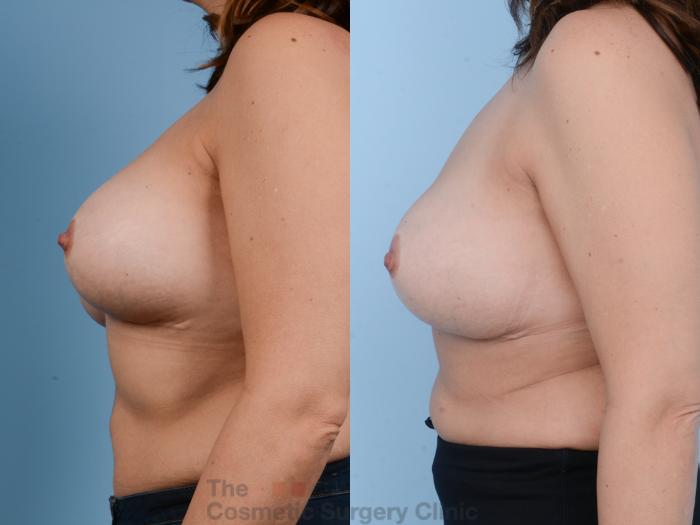 Before & After Breast Augmentation Case 358 View #8 View in Waterloo, Ontario