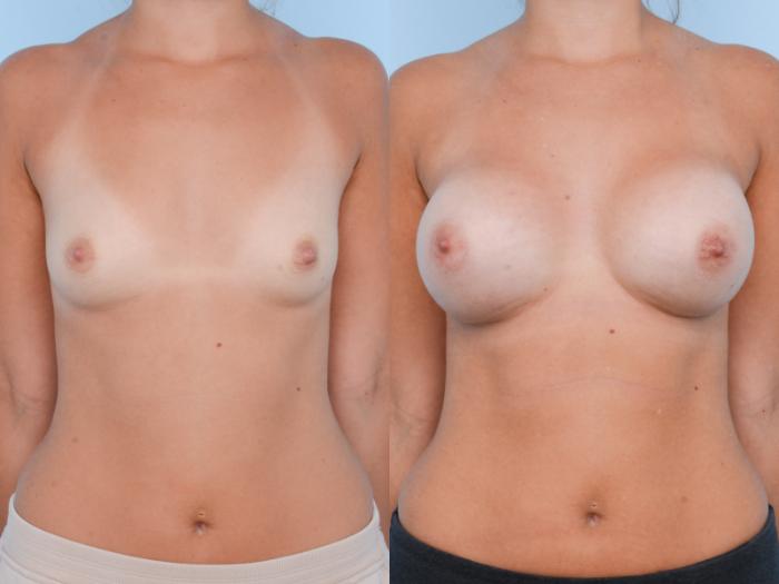 Before & After Breast Augmentation Case 372 View #1 View in Waterloo, Ontario