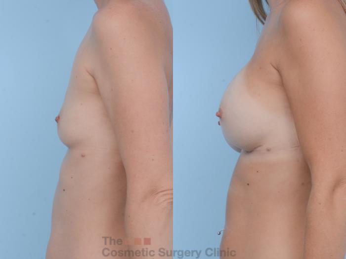 Before & After Breast Augmentation Case 387 View #2 View in Waterloo, Ontario