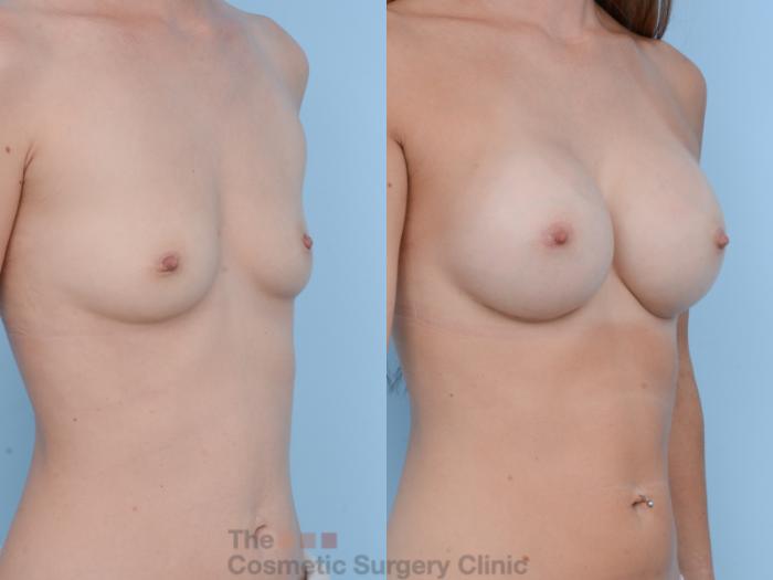 Before & After Breast Augmentation Case 387 View #4 View in Waterloo, Ontario