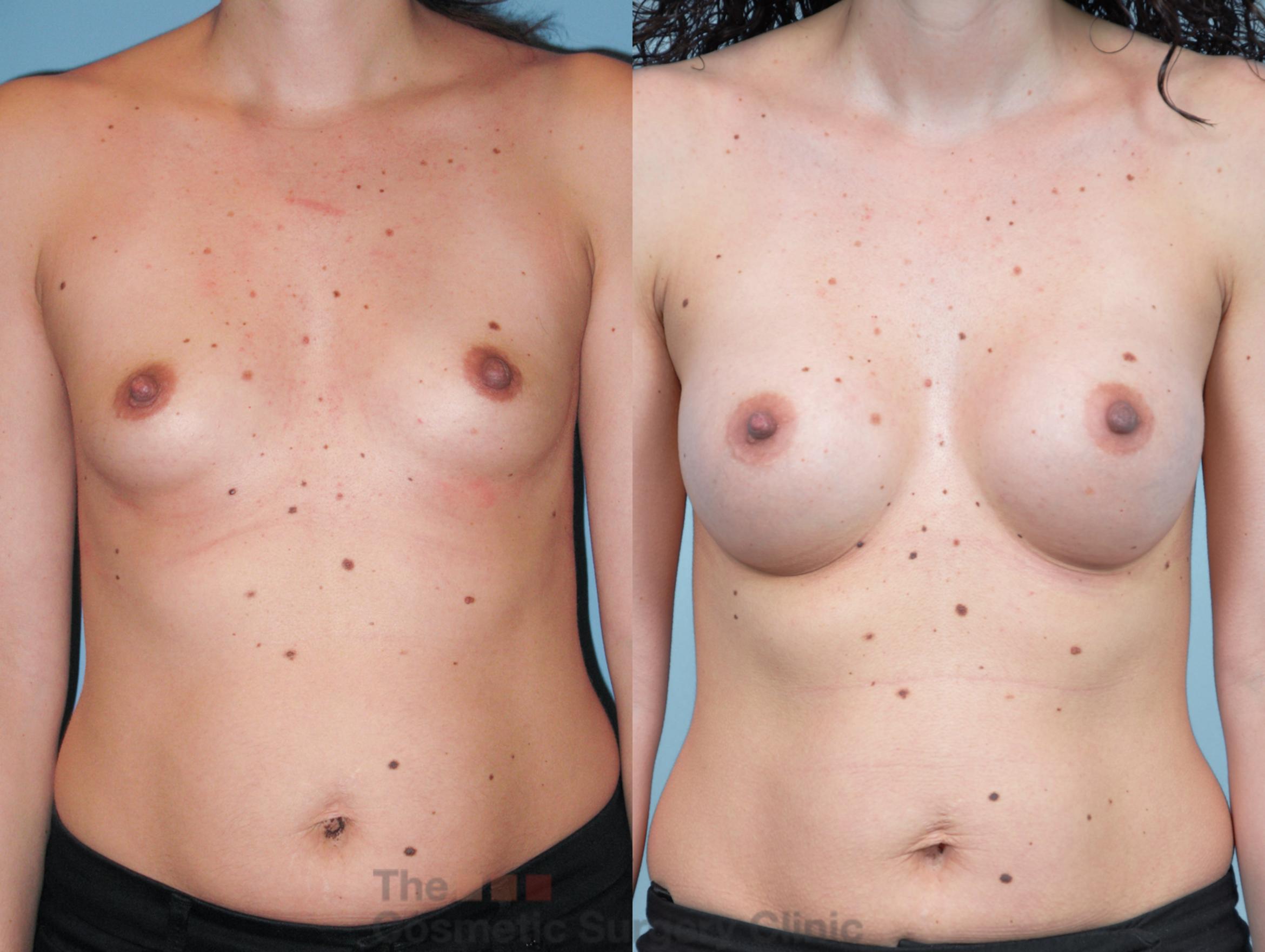 Before & After Breast Augmentation Case 400 View #1 View in Waterloo, Ontario