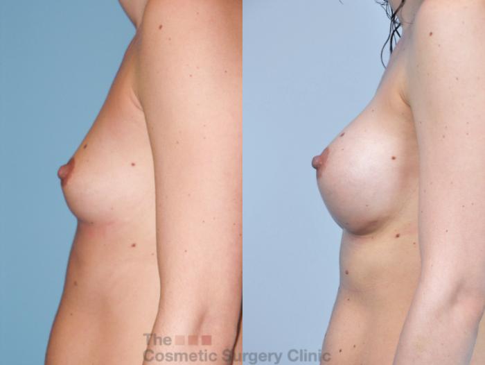 Before & After Breast Augmentation Case 400 View #2 View in Waterloo, Ontario