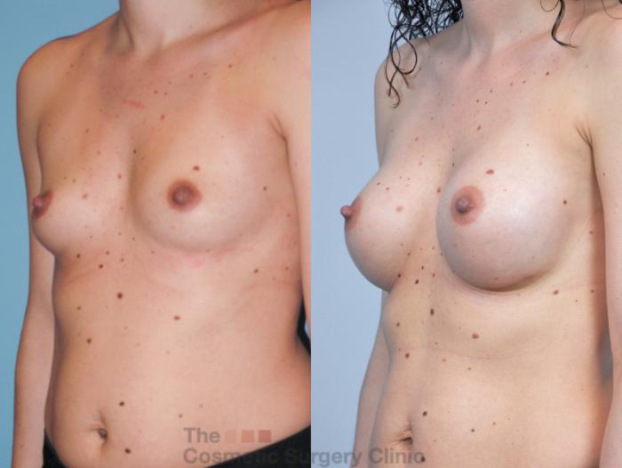 Before & After Breast Augmentation Case 400 View #3 View in Waterloo, Ontario