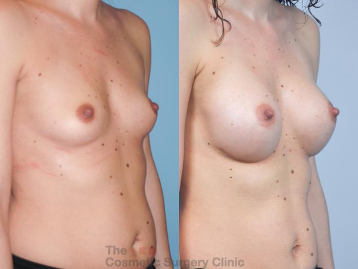 Before & After Breast Augmentation Case 400 View #4 View in Waterloo, Ontario