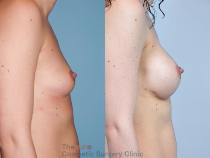 Before & After Breast Augmentation Case 400 View #5 View in Waterloo, Ontario