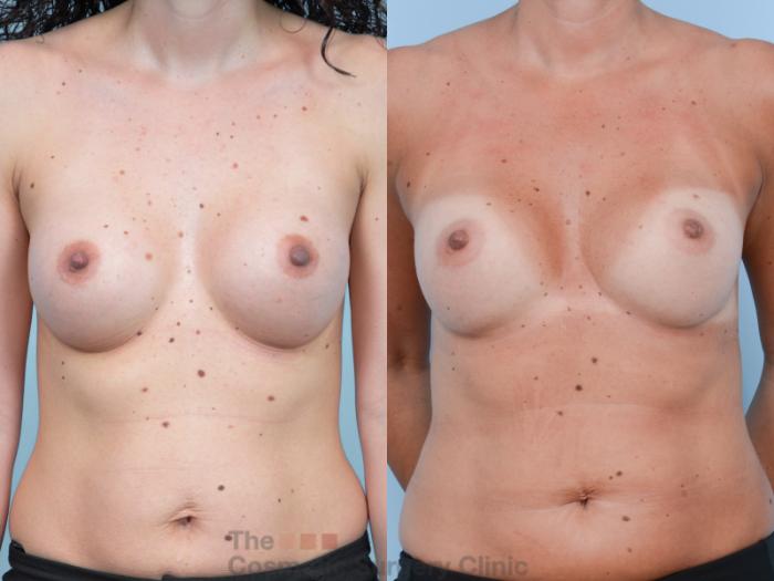 Before & After Breast Augmentation Case 400 View #6 View in Waterloo, Ontario