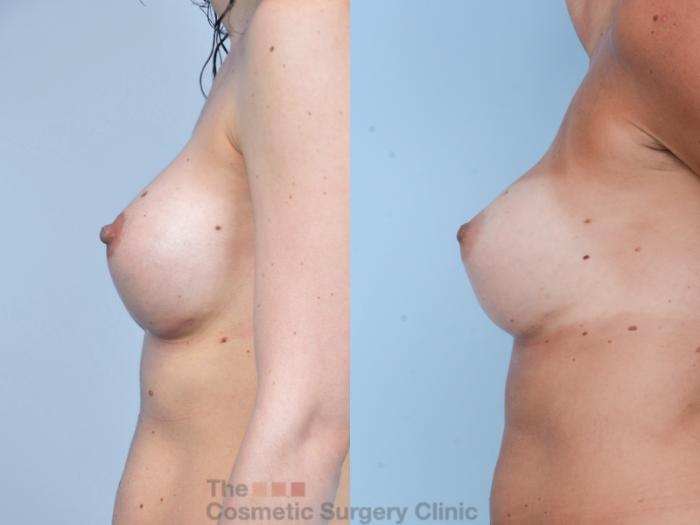 Before & After Breast Augmentation Case 400 View #7 View in Waterloo, Ontario