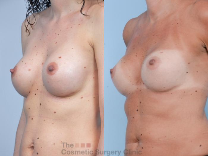 Before & After Breast Augmentation Case 400 View #8 View in Waterloo, Ontario