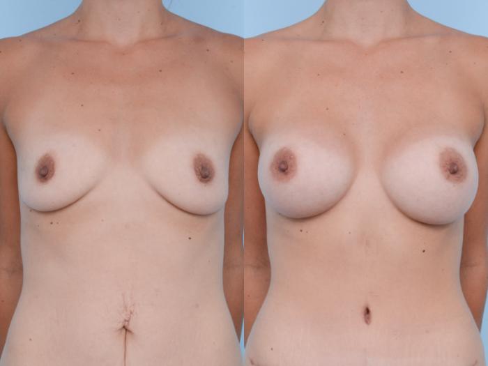 Before & After Breast Augmentation Case 406 View #1 View in Waterloo, Ontario