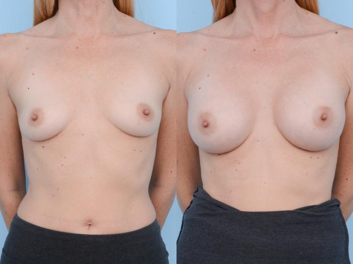 Before & After Breast Augmentation Case 432 View #1 View in Waterloo, Ontario