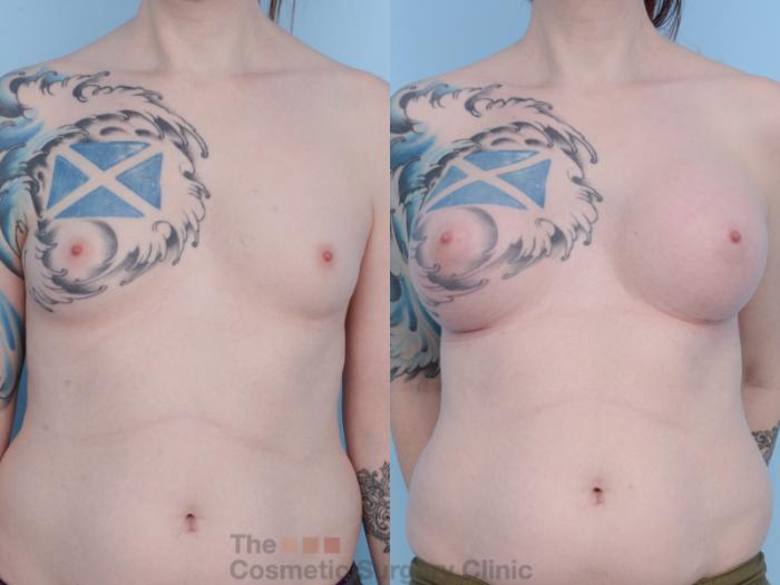 Before & After Breast Augmentation Case 455 View #1 View in Waterloo, Ontario