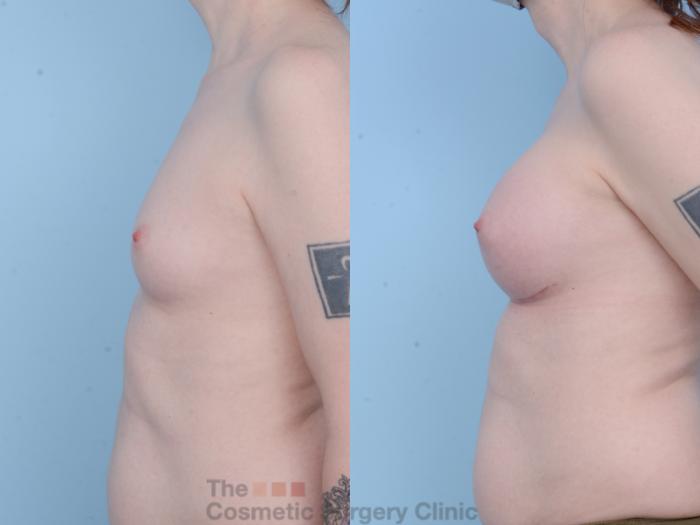 Before & After Breast Augmentation Case 455 View #2 View in Waterloo, Ontario