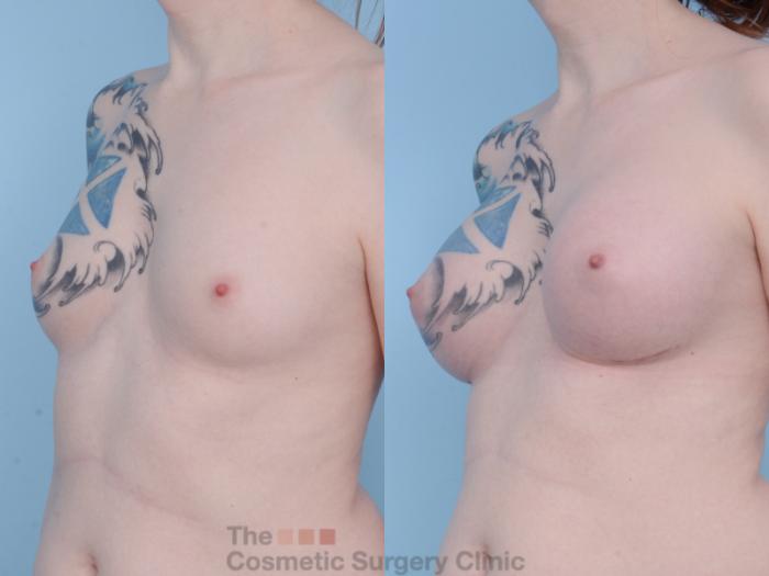 Before & After Breast Augmentation Case 455 View #3 View in Waterloo, Ontario