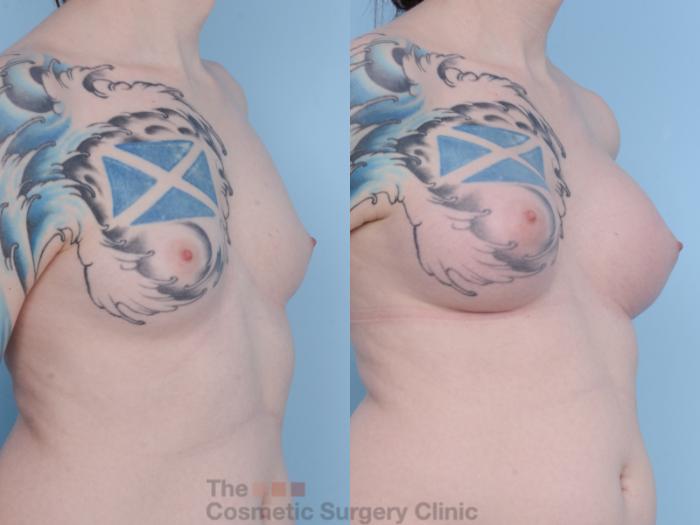 Before & After Breast Augmentation Case 455 View #4 View in Waterloo, Ontario