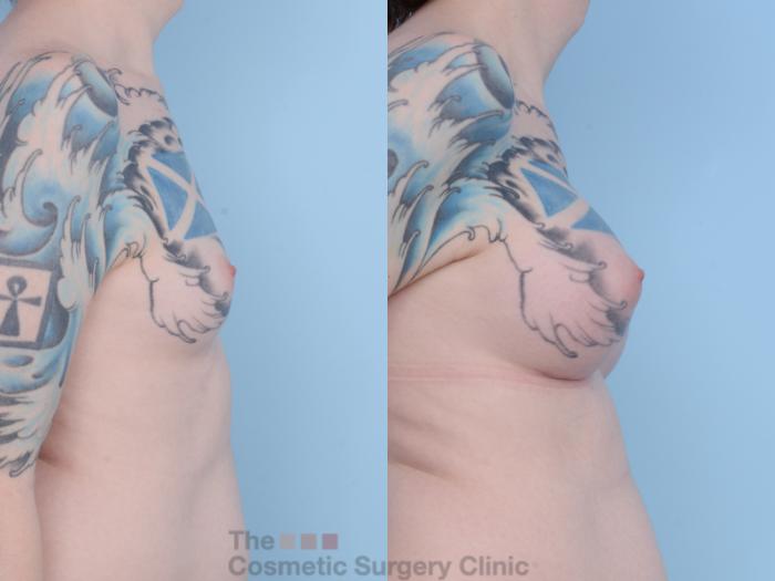 Before & After Breast Augmentation Case 455 View #5 View in Waterloo, Ontario
