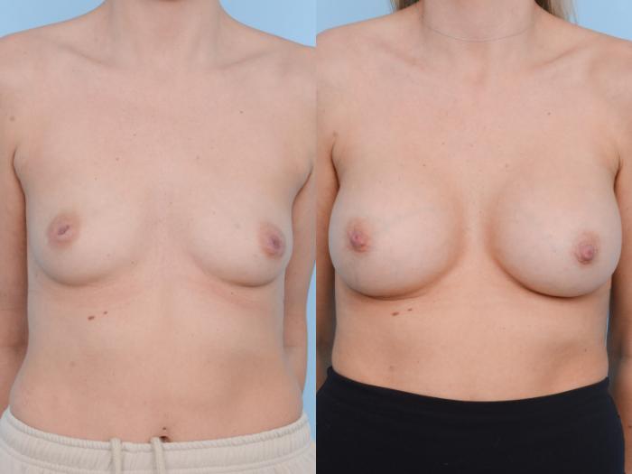 Before & After Breast Augmentation Case 478 View #1 View in Waterloo, Ontario