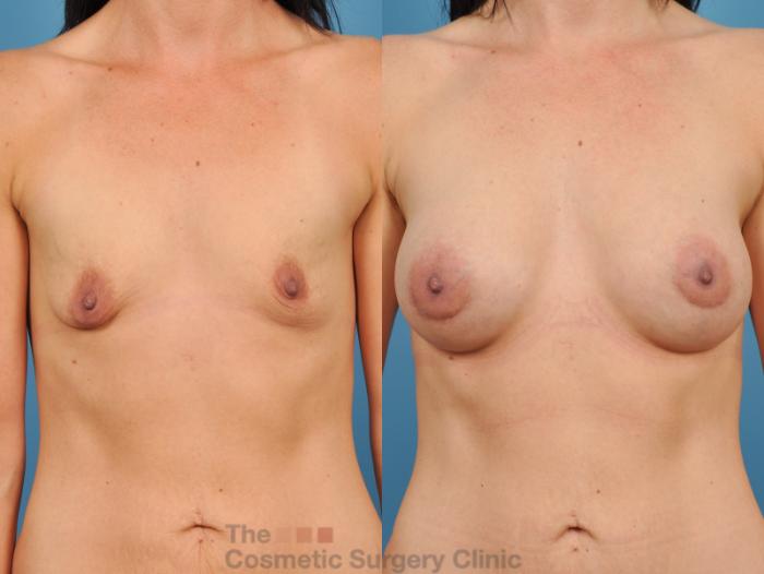 Before & After Breast Augmentation Case 49 View #1 View in Waterloo, Ontario