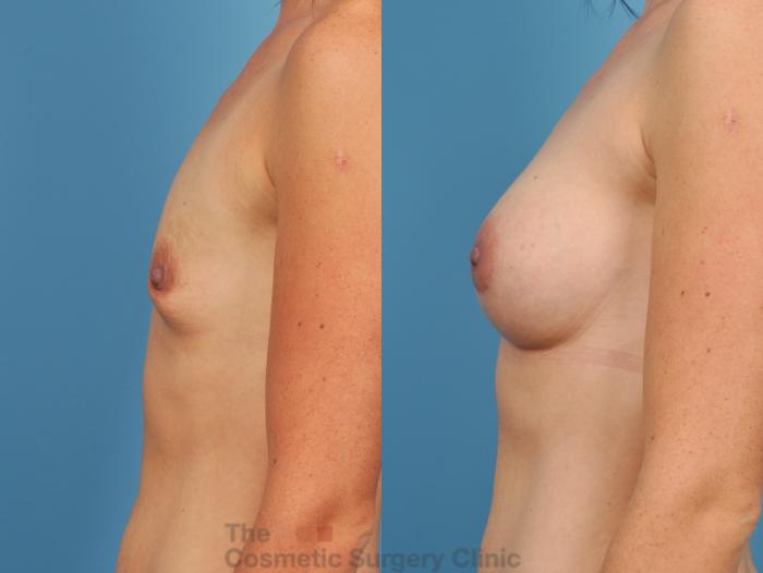 Before & After Breast Augmentation Case 49 View #2 View in Waterloo, Ontario