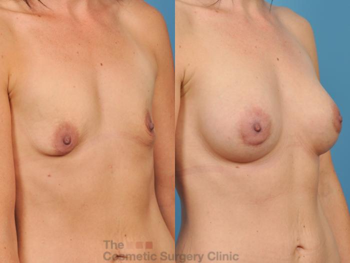 Before & After Breast Augmentation Case 49 View #3 View in Waterloo, Ontario