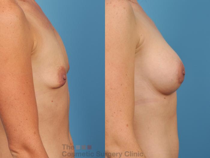 Before & After Breast Augmentation Case 49 View #4 View in Waterloo, Ontario