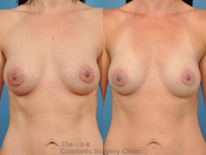 Before & After Breast Augmentation Case 49 View #5 View in Waterloo, Ontario