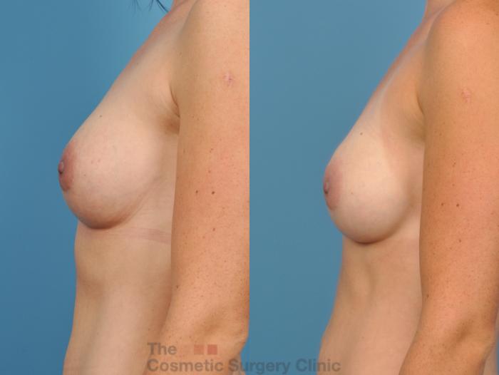 Before & After Breast Augmentation Case 49 View #6 View in Waterloo, Ontario