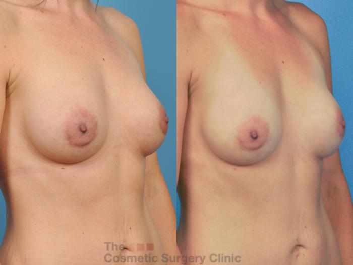 Before & After Breast Augmentation Case 49 View #7 View in Waterloo, Ontario